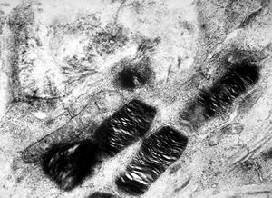M, 17y. | Fabry disease - skin M, 17y. | Fabry disease - skin